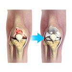 What is New in Knee Replacement