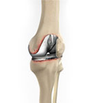 Total Knee Replacement