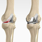 Knee Arthroscopy