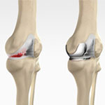 Unicondylar knee Replacement